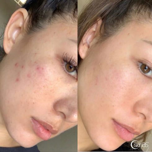 SkinB5 Extra Str Acne Support 120-Matakana Pharmacy